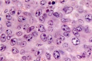 Лечение В-клеточных опухолей из периферических В-лимфоцитов в Израиле