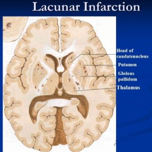 cyst lacunar brain