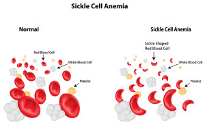 Лечение серповидноклеточной анемии в Израиле