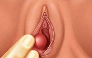 Лечение кисты половых губ в Израиле