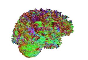 Лечение злокачественных опухолей мозга в Израиле: диффузионная тензорная визуализация