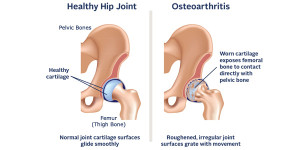 Лечение артроза (остеоартроза) тазобедренного сустава в Израиле