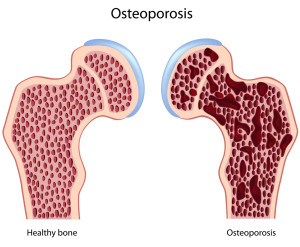Лечение остеопороза в Израиле