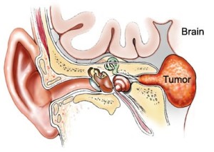Лечение опухоли среднего уха в Израиле